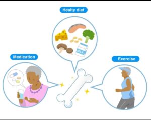How to Prevent Osteoporosis: Best Foods, Exercises, and Lifestyle Habits for Strong Bones